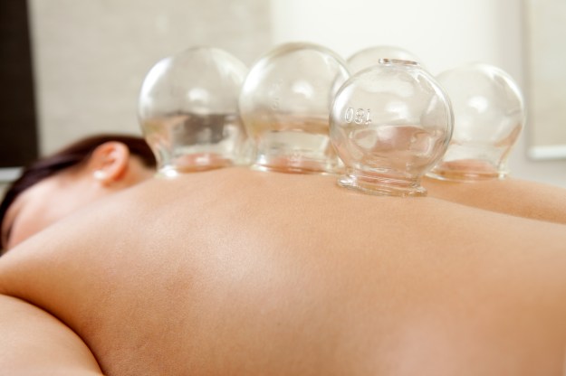 Fire cupping cups on back of female patient in Acupuncture therapy